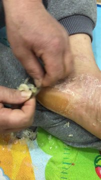 Il s’enlève la corne des pieds et c'est pas très beau à voir