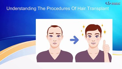 Understanding The Procedures Of Hair Transplant