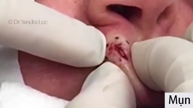 Những pha nặn mụn vi diệu sẽ giúp bạn xả stress khi cuộc đời quá mệt mỏi