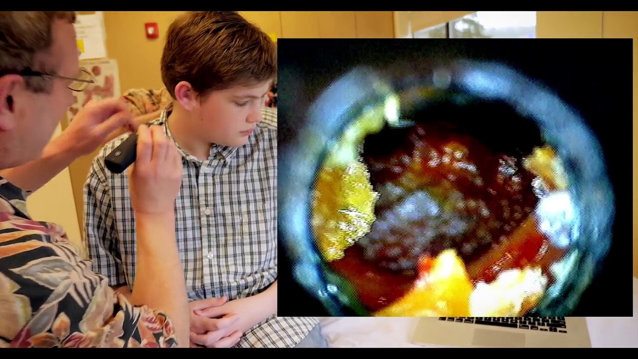 GIANT EAR WAX REMOVAL! | Dr. Paul