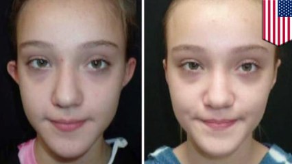 11-year-old gets 'elf ears' fixed after being bullied at school