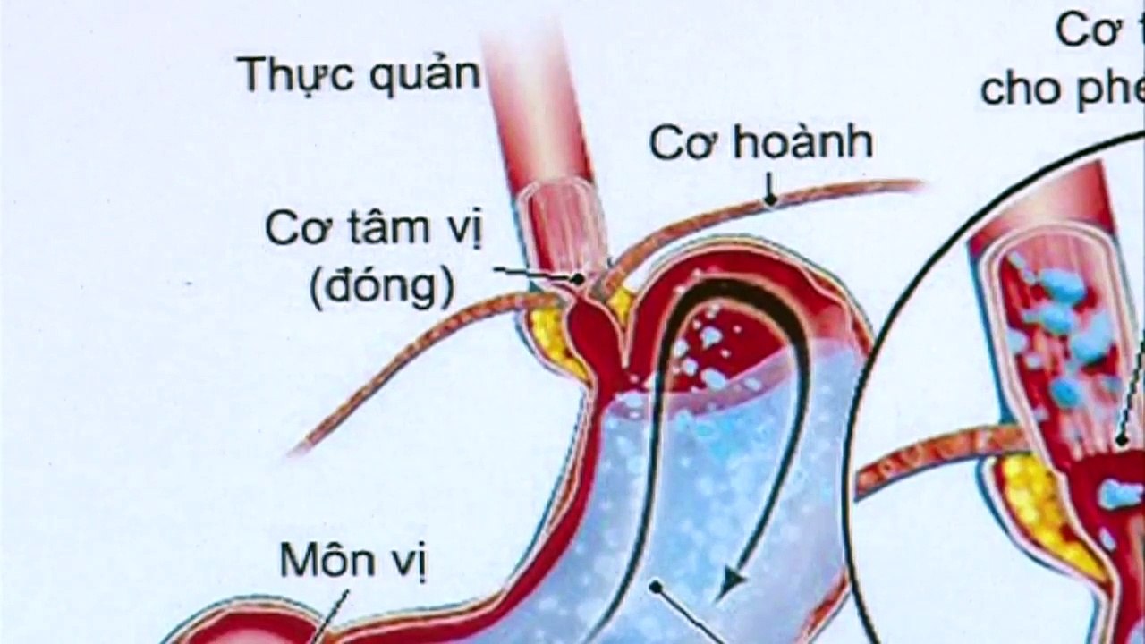 Trào ngược dạ dày thực quản ở trẻ nhỏ- nguyên nhân và biến chứng khôn lường