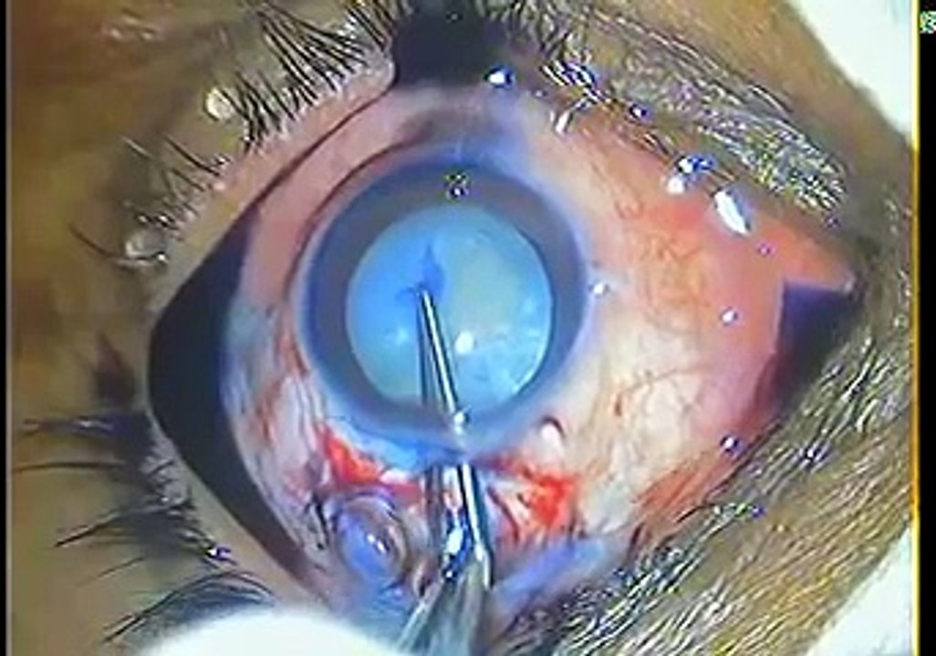manual contract surgery