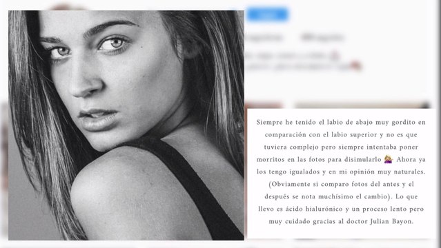 Laura Escanes revela su retoque estético