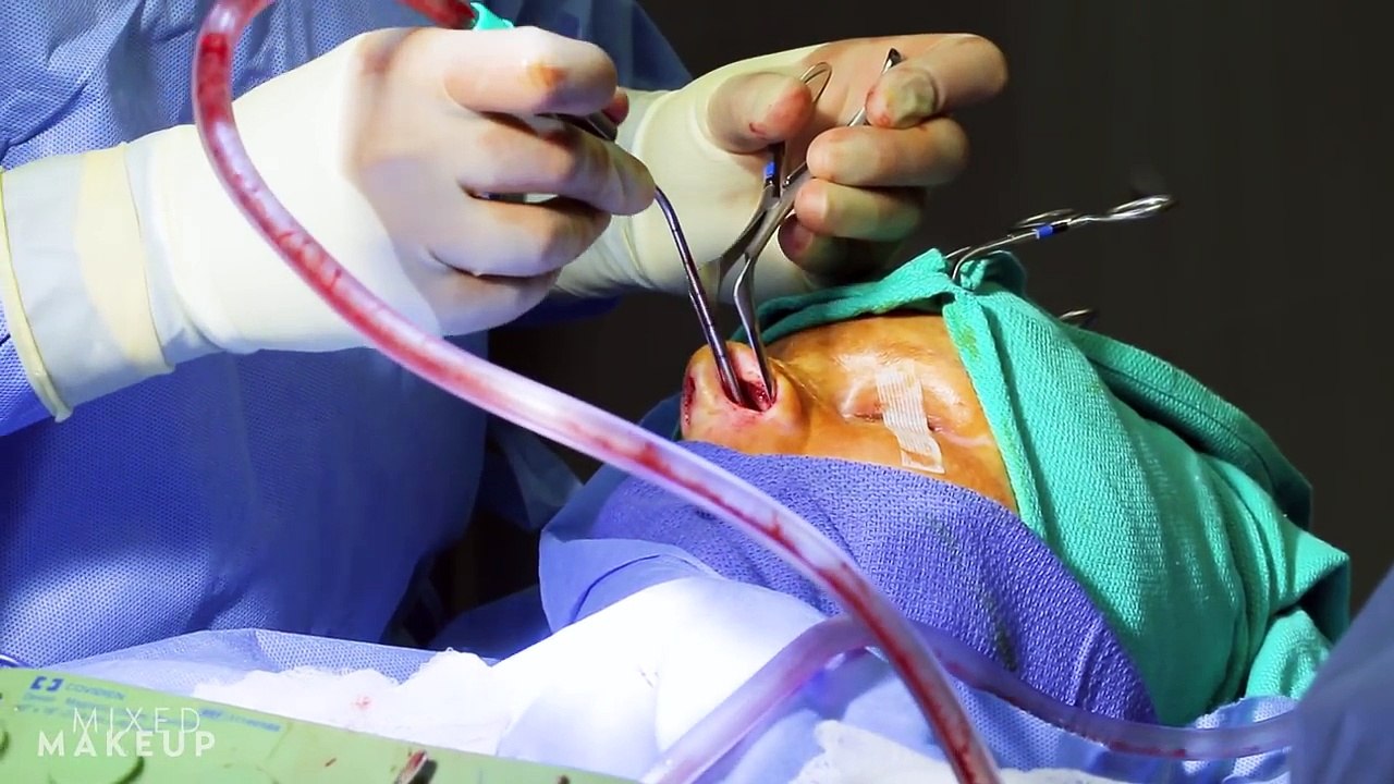 Rhinoplasty to Fix a Deviated Septum | PLASTIC with Dr. Dhir