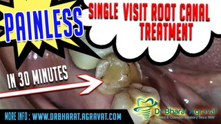 Root Canal Treatment in 30 min Painless Single Visit Procedure I China Patient Review Dr Bharat Agravat Ahmedabad India