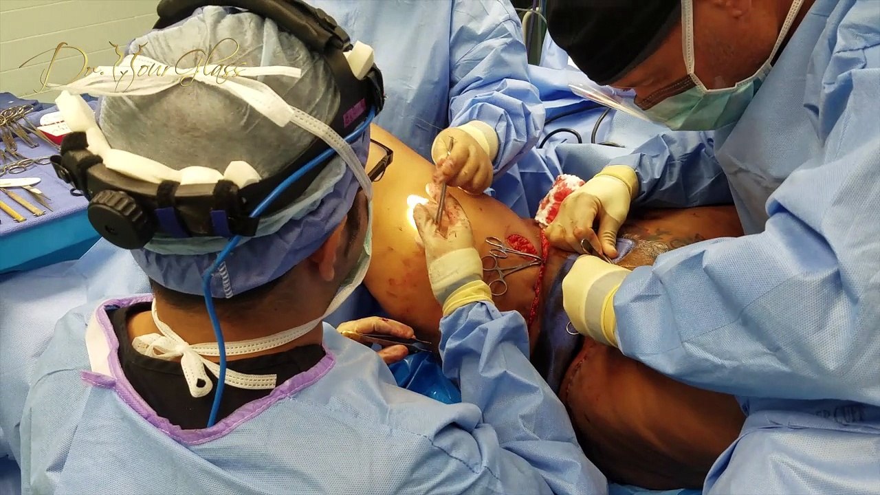When do you need a thigh lift?