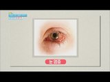 [Happyday] An inflamed eye should heal immediatelyl '눈 충혈', 방치하면 '독' 된다 [기분 좋은 날] 20160119