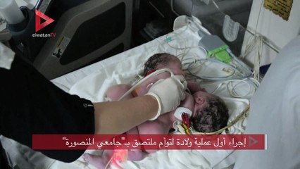 إجراء أول عملية ولادة لتوأم ملتصق بـ"جامعي المنصورة"