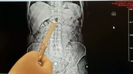 Midelerinden uyuşturucu çıktı - İZMİR