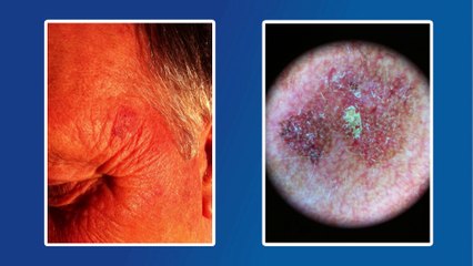 MSA, le conseil santé : prévention des cancers de la peau