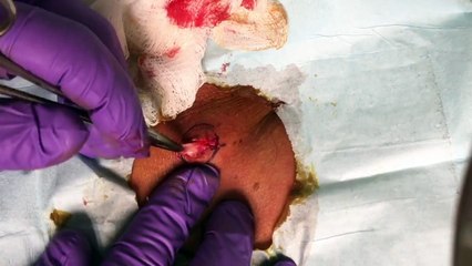 ***GRAPHIC*** TATTOOED SEBACEOUS CYST **POP** SQUEEEZE DR. MICHAEL LEWIS, MD