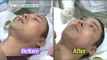 [Section TV] 섹션 TV - Jun Hyun-moo receive laser treatment 20170108