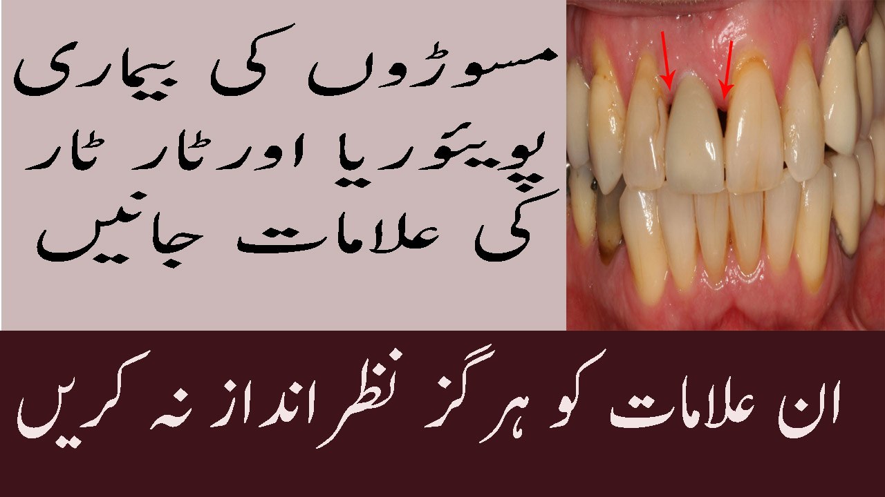 Masoro Ki Sujan Aur Uska Ilaj Masooron Se Khoon Aana Pyria And Tartar Gum Disease Symptoms In Urdu