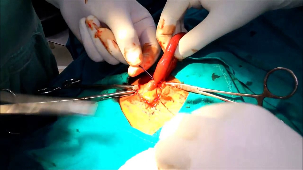 Appendectomy - Removal of Inflammed Vermiform Appendix