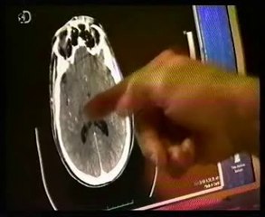 Cerebro (NDE): Experiencia cercana a la muerte (Eben Alexander)