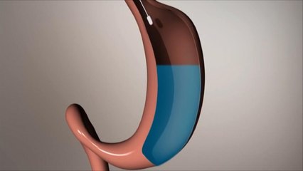هذا الصباح- بالون المعدة أحدث وسائل إنقاص الوزن