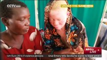 Albinism In Tanzania: UN officials propose GPS tracking on albino children