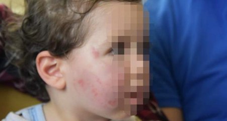 Kreşte 1,5 Yaşındaki Bebeğe Dayak! Yüzü Mosmor ve Isırıklarla Dolu