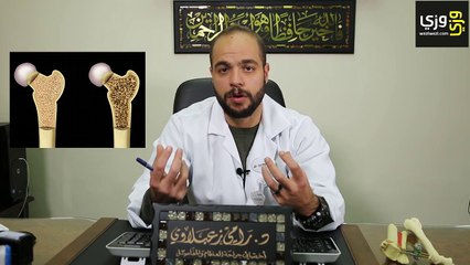 أسباب وأعراض هشاشة العظام وكيفية علاجها