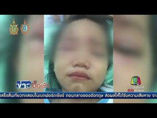 สลด ด ญ 3 ขวบ ถูกสุนัขหน้าเซเว่นฯ กระโดดงับหน้าเหวอะ l ข่าวมื้อเช้า l 25 ส.ค.59