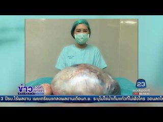 แพทย์หนองคายผงะ! ผ่าเนื้องอกรังไข่หญิงลาว หนัก 8 กก. l ข่าวเวิร์คพอยท์ l 16 พ.ค.60
