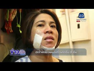 เปิดใจสาวช่วยหมาแต่โดนกัดเย็บ 8 เข็ม l ข่าวเวิร์คพอยท์ l 30 พ.ย. 60