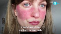 Rosacea sufferer Lex says it's hard to be honest about her skin online