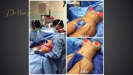 What you should know before scheduling your mommy makeover