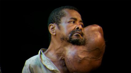 Un homme vit avec une tumeur depuis plus de 30ans