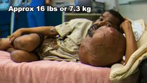 Operohet njeriu me tumor 7.3 kg në fytyrë, ja c’i bënë