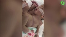 Cette maman a donné naissance à des bébés siamois. Incroyable