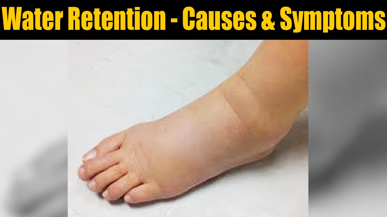 Water Retention Causes and symptoms; Check out here Boldsky video