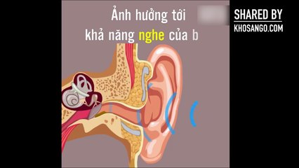 Bạn có dùng bông ngoáy tai hàng ngày Hãy xem video để biết tác hại việc đó.