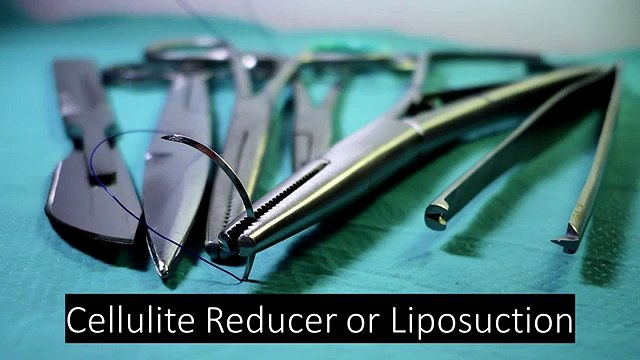 Cellulite Reducer or Liposuction