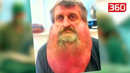 Operohet njeriu me tumor 6.3 kg në fytyrë, ja si duket tani pas operacionit (360video)