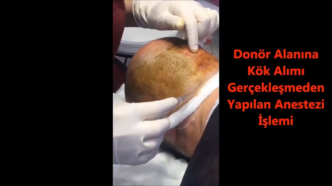 Donor-alanina-kok-alimıi-gerçeklesmeden-yapilan-anestezi-islemi