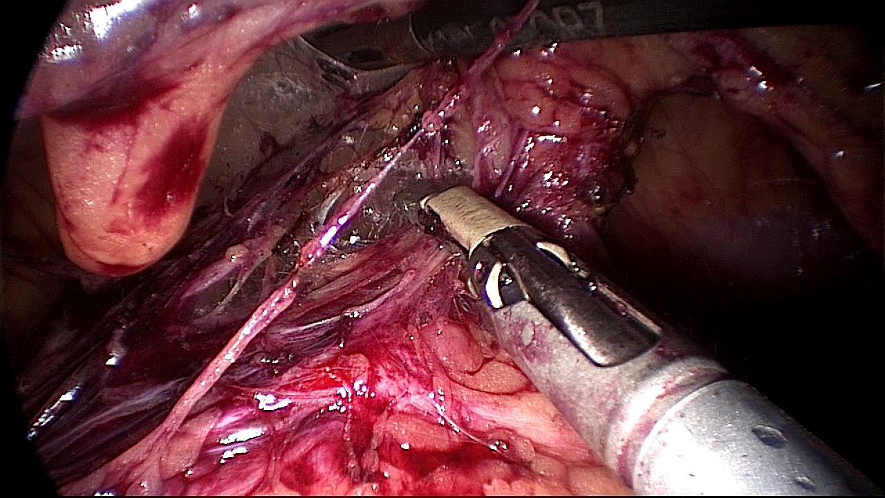 Lymphadenectomie aortique rétropéritonéale