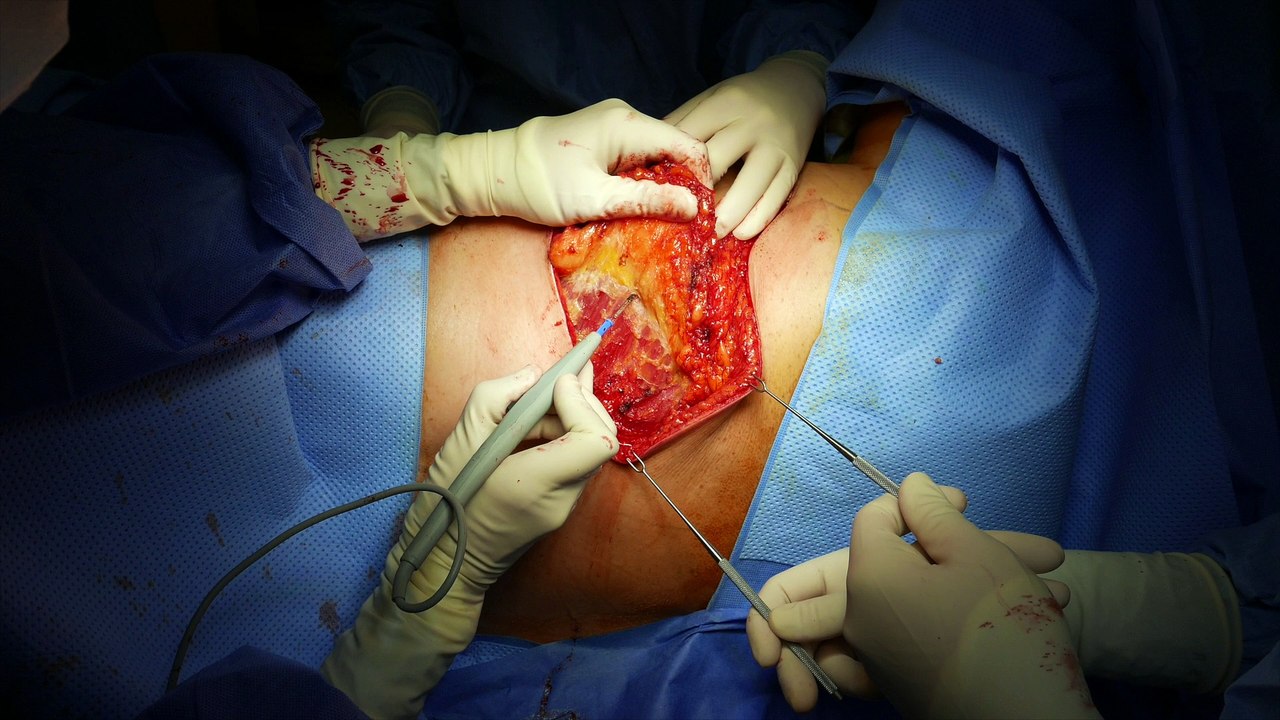 TAP Flap (Thoracodorsal Artery Perforator Flap) en reconstruction mammaire