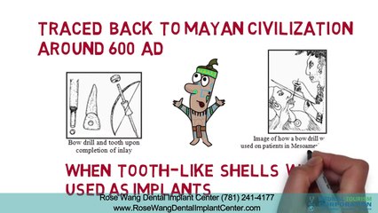 Dental Implants Facts Lexington MA