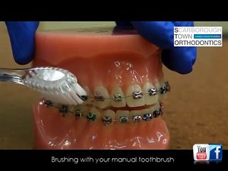 Oral Hygiene Instructions while in braces