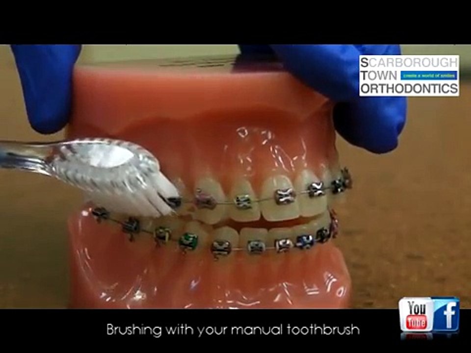 Oral Hygiene Instructions while in braces