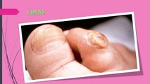 How to remove Corns and Calluses from feet, toes, hands naturally at home