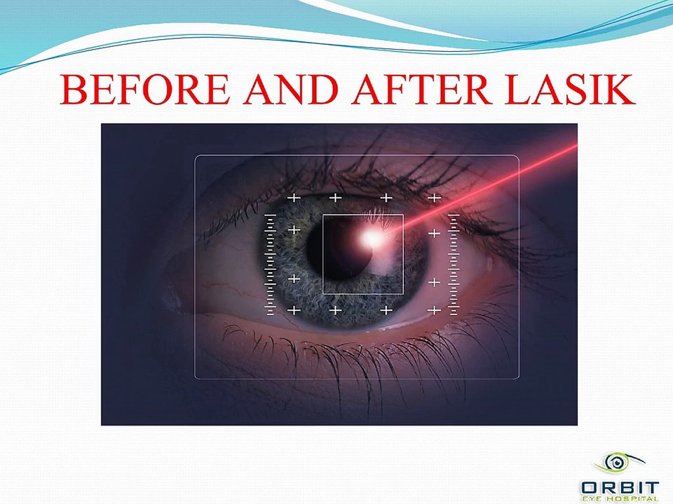 BEFORE AND AFTER LASIK