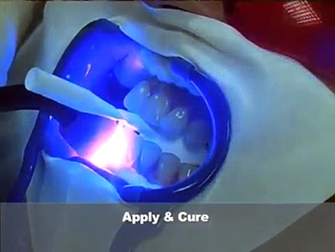 Dental teeth whitening (teeth bleaching)