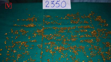 Over 2,300 Gallstones Removed from Woman in Single Surgery