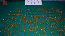 Over 2,300 Gallstones Removed from Woman in Single Surgery