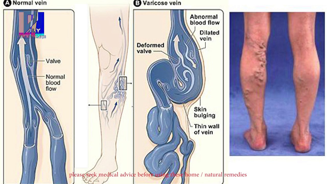 Varicose Veins Treatment   वेरीकोस वेंस का घरेलू और असरदार उपाए   Daily Health Care