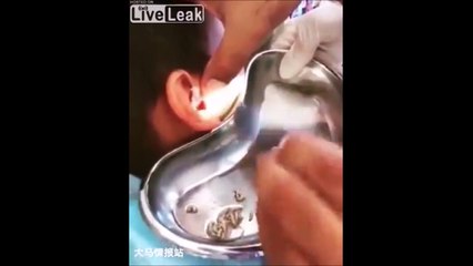 Ce qu'il retire de l'oreille de cet homme est HORRIBLE