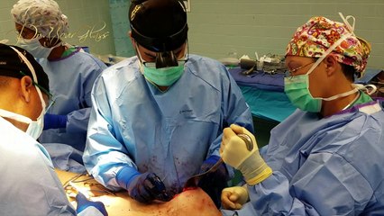 How many hourglass procedures can I have in one sitting?